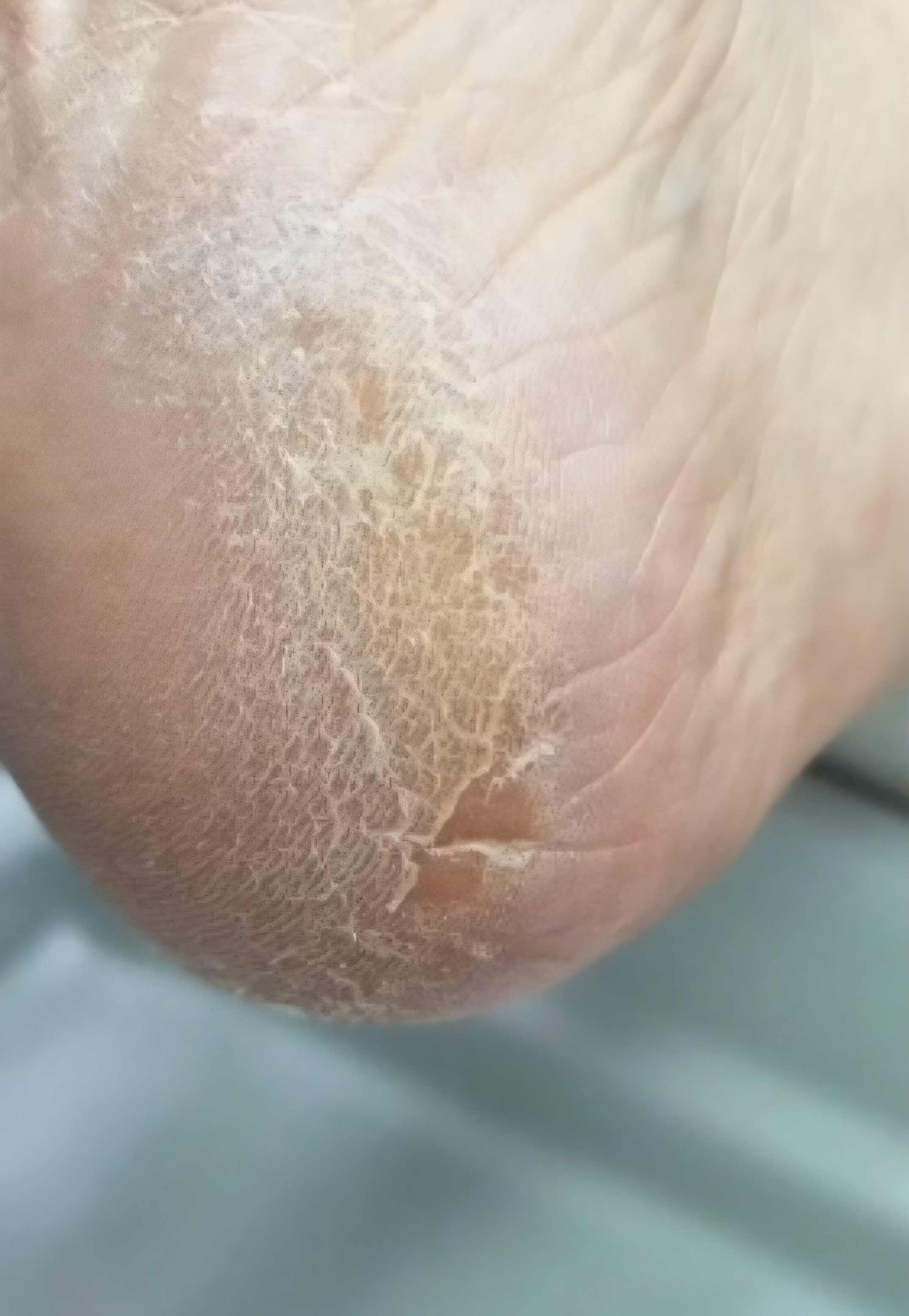 Tratamento de Ressecamento