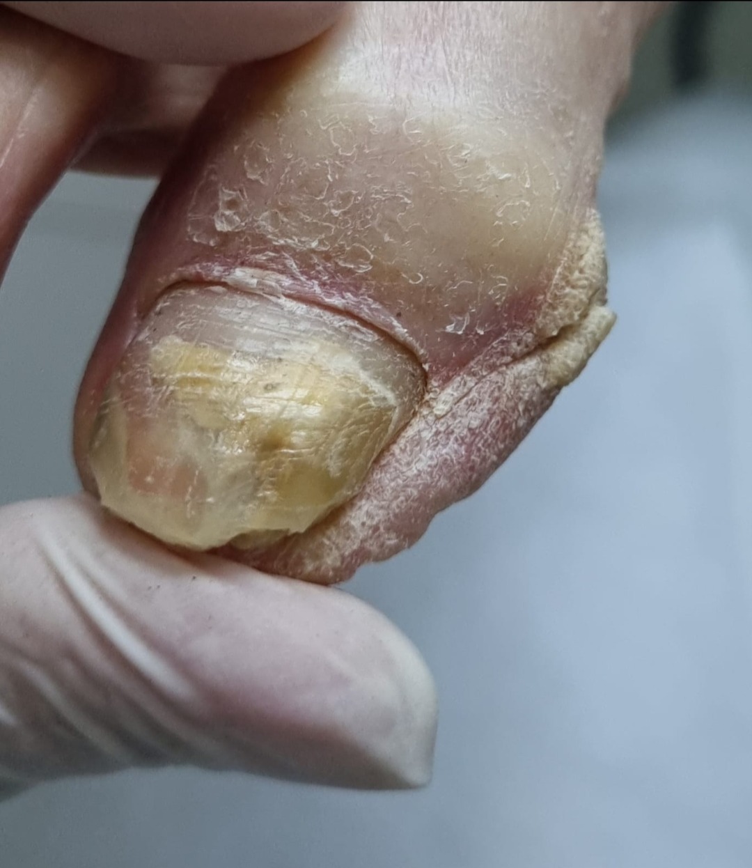 Tratamento de Micose