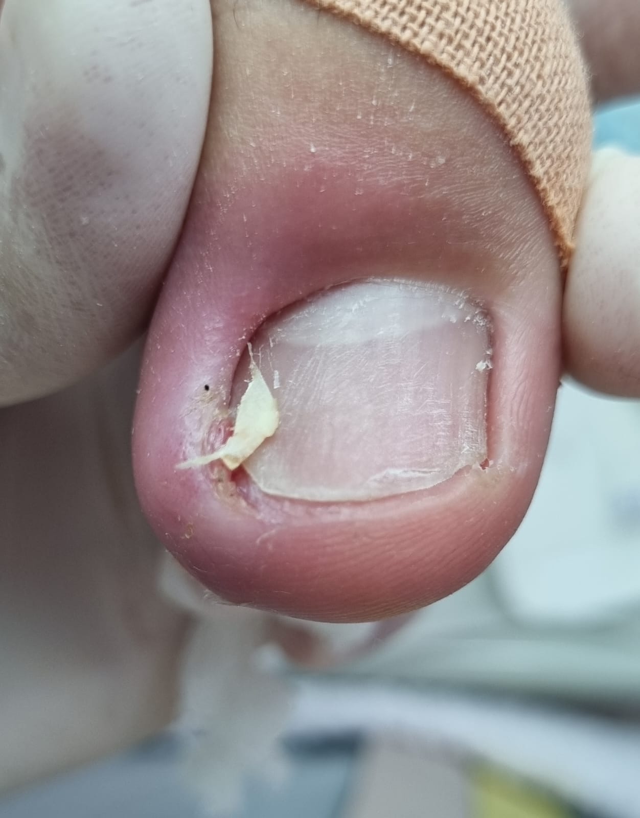 Tratamento de Unha Encravada